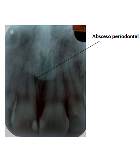 coirm's tweet photo. Tratamiendo endodóntico realizado en incisivo central superior, paciente presenta absceso en tejidos periodontales http://t.co/izfnU6eYVx