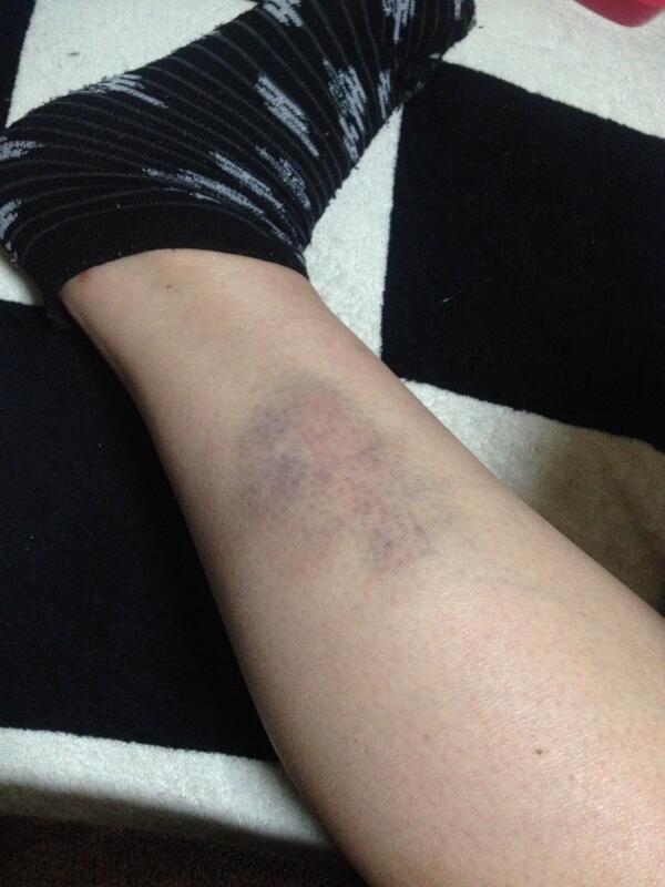 コクハ こういう痣が左半身にいっぱい出来ました 気持ち悪い皮膚です どんどん色濃くなるからなー 早く治ってほしい Http T Co 4baarqbj4p