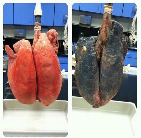 HechosEnElMundo's tweet image. Pulmones sanos y pulmones de un fumador.