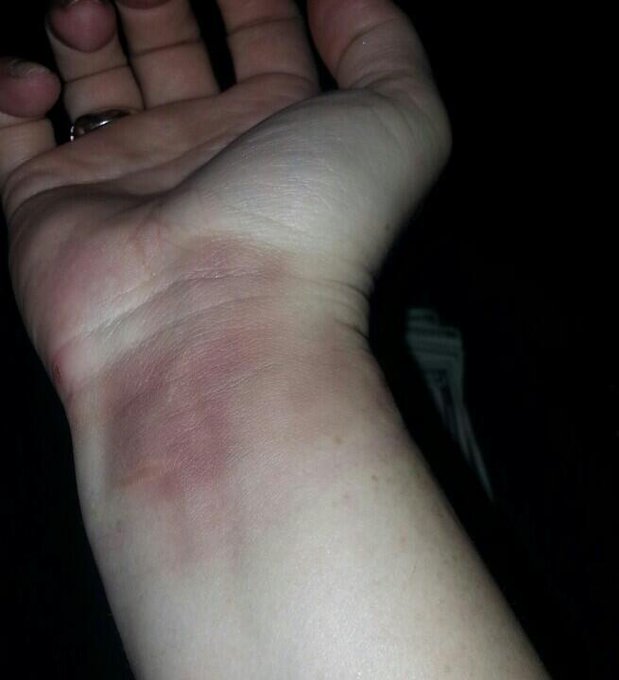 Bruise of the week 2 weeks ago! http://t.co/ki8Z1qCfpP