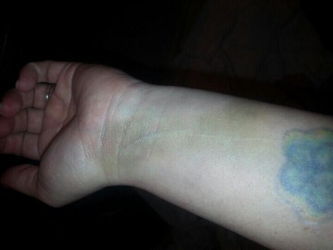 Bruise of the week one week ago. http://t.co/1VAaXQwIAL