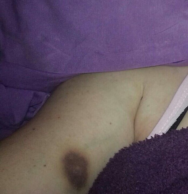 Bruise of the week from this weekend. http://t.co/5zaC6fZ1yM