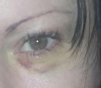 And for the non work bruise compliments of the pupperdups. . My black eye! http://t.co/0yo7UOpir3