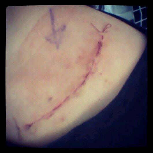 Are you jealous? 

You shouldnt be, its grim. #horseridingaccident #operation #plateremoved #backtonormal #scar #cut