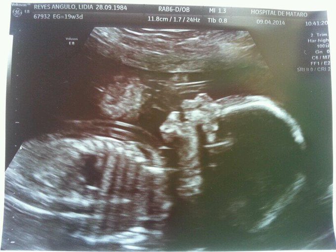 Es una nena y se llamar&aacute; Zoe! ! :) http://t.co/UKXDmP6g4X