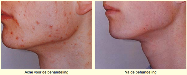 stadskliniek's tweet image. Wij stellen de hoogste eisen aan de kwaliteit van onze behandelingen &amp;amp; het resultaat ervan... stadskliniekutrecht.nl/lasercentrum