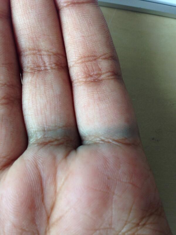 _ANJALINDIA_'s tweet image. 😭 #ringproblems