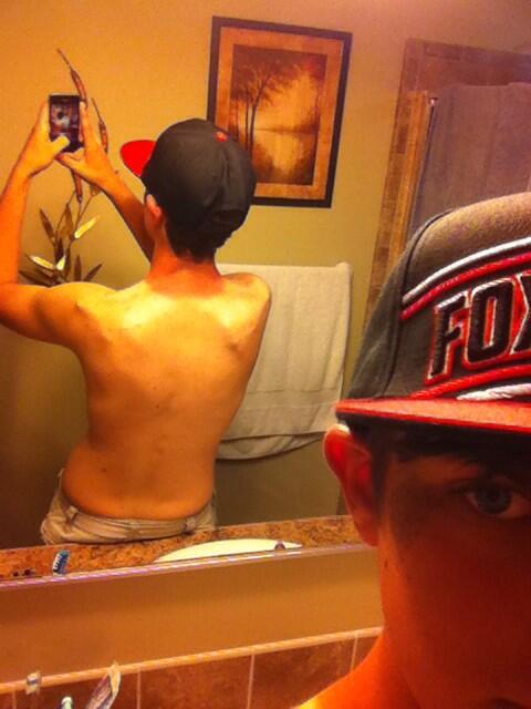 AustinMichigan's tweet image. Got burnt offshore fishing yesterday