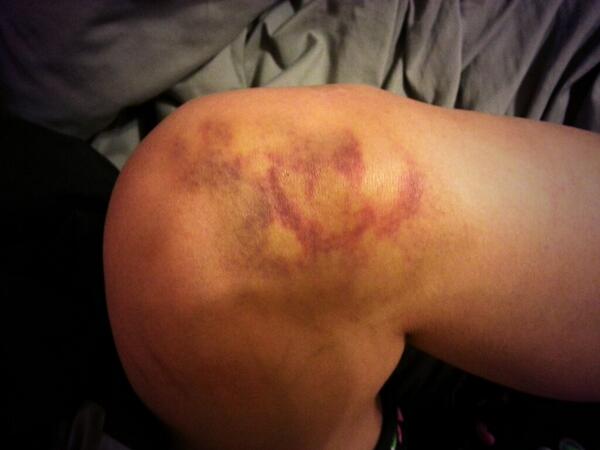 Busted and disgusted <a href="/saywhatny/">Say What?</a> <a href="/everskatedotcom/">Everskate.com</a> @comeonfreakout let me know if you can make out my knee weiner. Haha