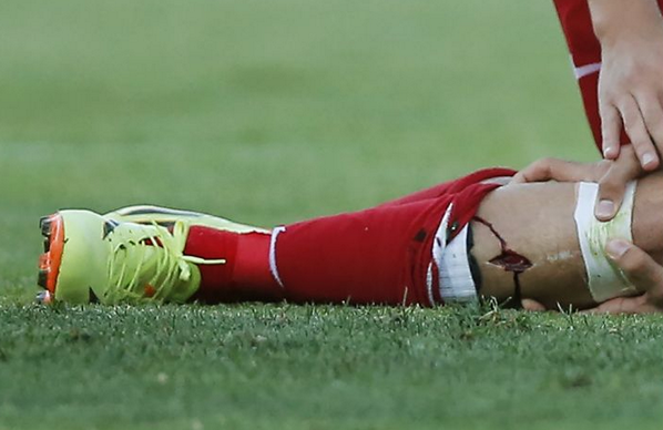 FootballFunnys's tweet photo. Graphic picture of Diego Costa's injury yesterday! Ouch! http://t.co/sYgh6Q4MXC