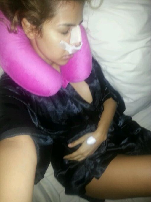 Ya por fin d reposo en mi camita, hoy @drlinolinares dejo bella mi nariz solo en las manos del mejor<a class="tags" target="_blank" title="On Twitter" href="/?out=eyJ0eXAiOiJKV1QiLCJhbGciOiJIUzUxMiJ9.eyJpYXQiOjE3MjA2Mzg1MTcsImlzcyI6InR3cG9ybnN0YXJzLmNvbSIsIm5iZiI6MTcyMDYzODUxNywiZXhwIjoxNzUyMTc0NTE3LCJyZWRpcmVjdF91cmwiOiJodHRwczovL3R3aXR0ZXIuY29tL2RybGlub2xpbmFyZXMifQ.wCjqyORe7Pah7x9Ls9qVQBpOn9loeR_VdmG5DGej2uPYYRU-17G_QYK_FTlXy3ICmbqRY6FSwyUK8U5MV_1_6Q">@drlinolinares</a><a href="/tag/angelserotic"class="tags"><span>#angelserotic</span></a>