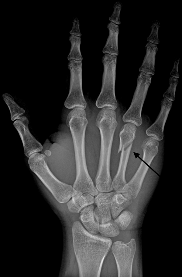spirit_mma's tweet image. X-Ray hand @roynelsonmma after fight vs @Minotauromma @ufc #UFCFightNight #ufcabudhabi