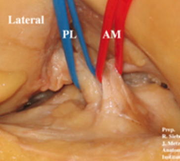 trauma_modern's tweet image. Magnífica imagen anatómica del LIGAMENTO CRUZADO ANTERIOR con su haz doble: anteromedial (AM) y posterolateral (PL)