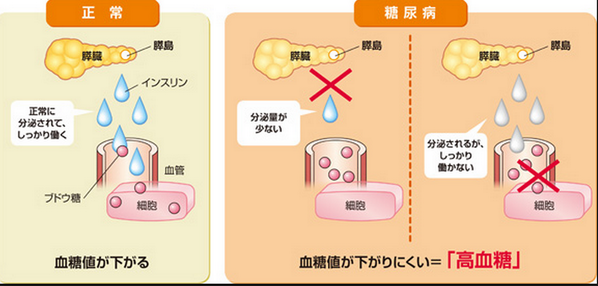 ゴロ 解剖生理イラスト Ar Twitter 糖尿病の血糖値が上がる２つのパターン T Co Qzsbnwmdhs