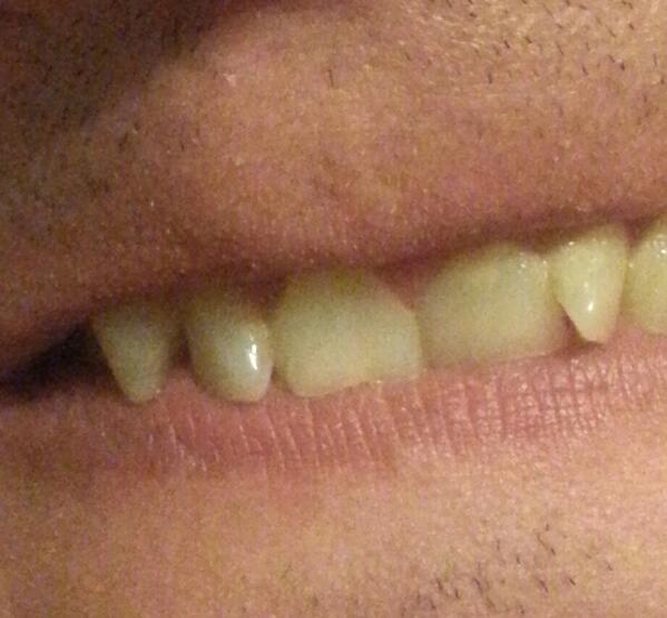 DBCloggy's tweet image. @MyFaceBothered ;-)  #toothforatooth