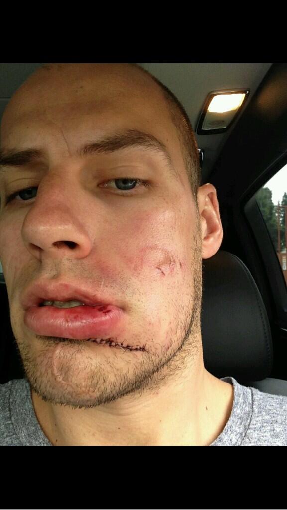 Hockey Scars Scarshockey Twitter