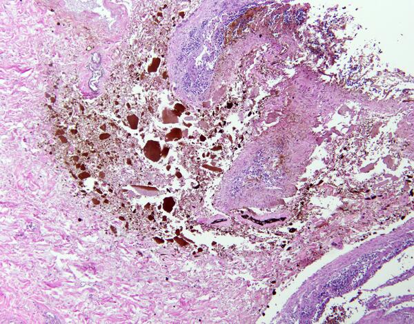 deathunderglass's tweet image. Image of the day: Wischnevsky ulcer of gastric mucosa due to prolonged hypothermia #histology #pathology #forensicmed