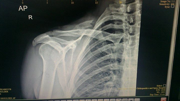 Had to happen sooner or later, fractured my Clavicle - #ooops