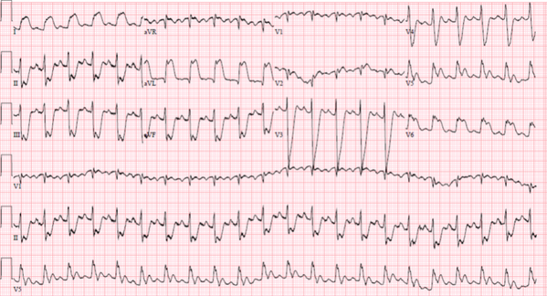 smithECGBlog's tweet image. #FOAMed #ECG #codeSTEMI A 16 yo girl has syncope:  hqmeded-ecg.blogspot.com/2014/05/a-16-y…