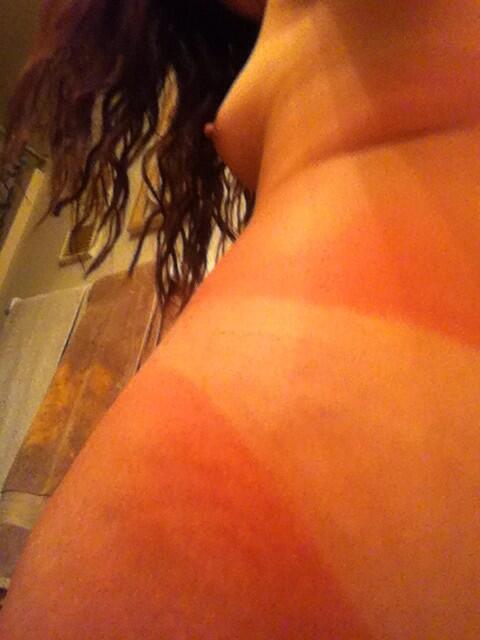 #sunburnt #red #didsomeoneorderalobster #boob #tanline #ouch http://t.co/4jkBOVoQB3<a href="/tag/sunburnt"class="tags">#sunburnt</a><a href="/tag/red"class="tags">#red</a><a href="/tag/didsomeoneorderalobster"class="tags">#didsomeoneorderalobster</a><a href="/tag/boob"class="tags">#boob</a><a href="/tag/ouch"class="tags"><span>#ouch</span></a><a href="/tag/tanline"class="tags"><span>#tanline</span></a>