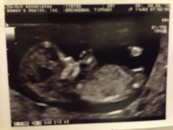Babybrenneman's tweet photo. I'm back. In other news, I can suck my thumb. Bam. http://t.co/PjWHtsY4HB