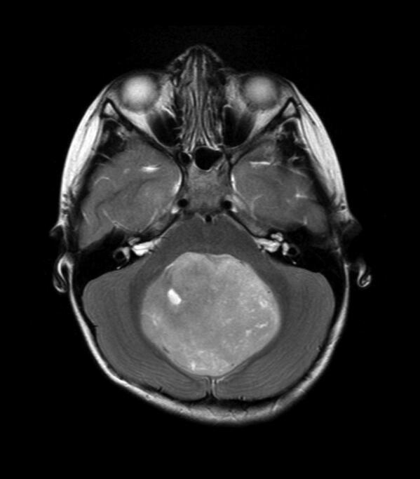 CancerCureNow's tweet photo. MT/RT
Medulloblastoma is a highly malignant primary brain tumor that originates in the cerebellum or posterior fossa.https://t.co/ix12OY6h0S