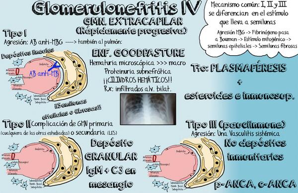 TheDocNeverDies's tweet photo. GMN IV:última infografía sobre el tema:Rápidamente progresiva.Sd. GOODPASTURE @Estudimed @Medicoblastos Ánimo #2MIR15 http://t.co/1W8qV7vOB6