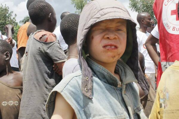 Engage_REACT's tweet photo. An albino child at the #REACT2014 Bujumbura. The children where taught about proper hand washing and hygiene. http://t.co/RfSqeXc9T6