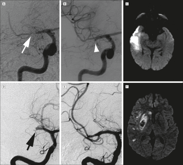 JAMA_current's tweet photo. Equal proportions of people express willingness to consent to stroke #thrombolysis, #CPR #http://ja.ma/1qUIpG6 #AIS http://t.co/Al6NxFEMNf