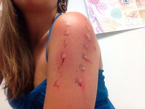 KellyBenedict2's tweet photo. #allergytesting #ouchie http://t.co/ybVZ0kpJDE