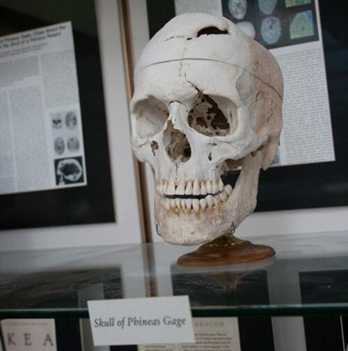DanielTejedor's tweet photo. Cráneo real del famoso paciente Phineas Cage que sufrió una lobotomización accidental el 1848 y vivió para contarlo. http://t.co/WKgcLQDOIM