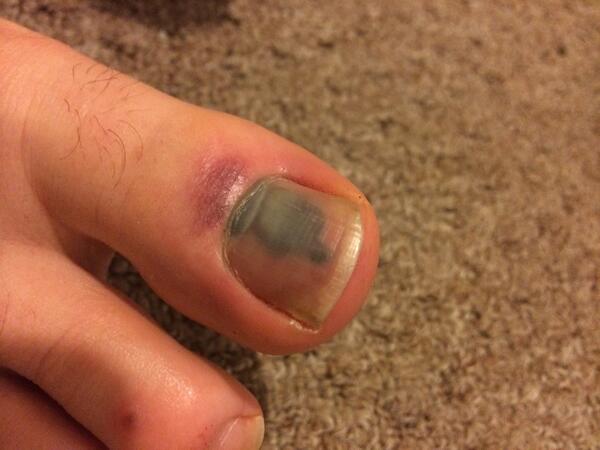 Therichwren's tweet photo. Broken toe ain't keeping me down http://t.co/Bw8zYmH9zA