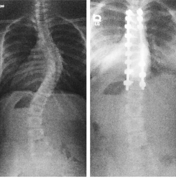delaneyholz's tweet photo. two years since ma surgery 🌼 #scoliosis #april30th http://t.co/4wd9dBBQAp