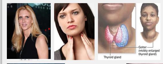 SaraJoRomero's tweet image. Googled "goiter" and this came up lol #anncoulter  #googlefun