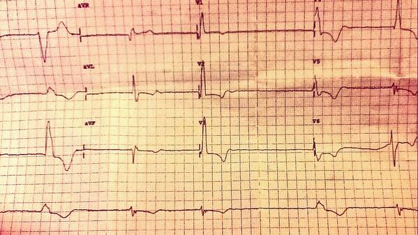 nadiastock's tweet image. Fab patient in ambulatory &quot;i have been bit tired but im 88 you know!&quot; #ecgclass #acutemed #otherreasonsfortiredness