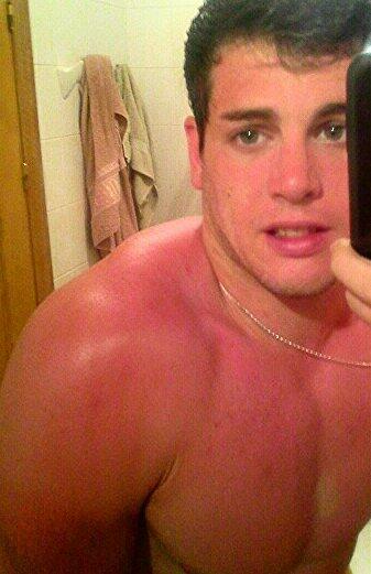 Peter6_MC's tweet photo. Pasando el dia aqui aburrio estoi muy quemao (literalmente) moreno gamba puaff como duele... ojala se me pase ptonto http://t.co/WSMj8wZzKm