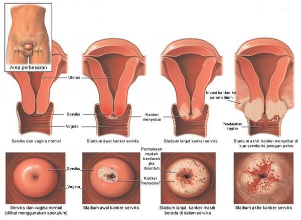 Inilah Penyebab Dan Gejala Kanker Serviks (Cervical Cancer) - AnekaNews.top