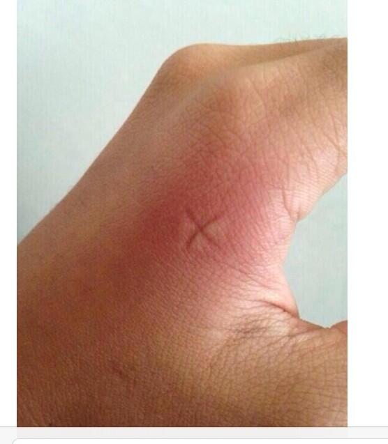 FloridaProblemz's tweet image. Doing this when they have a mosquito bite....