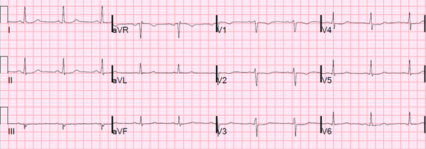 smithECGBlog's tweet image. A middle aged woman with reproducible chest pain #FOAMed #ECG: hqmeded-ecg.blogspot.com/2014/05/a-woma…