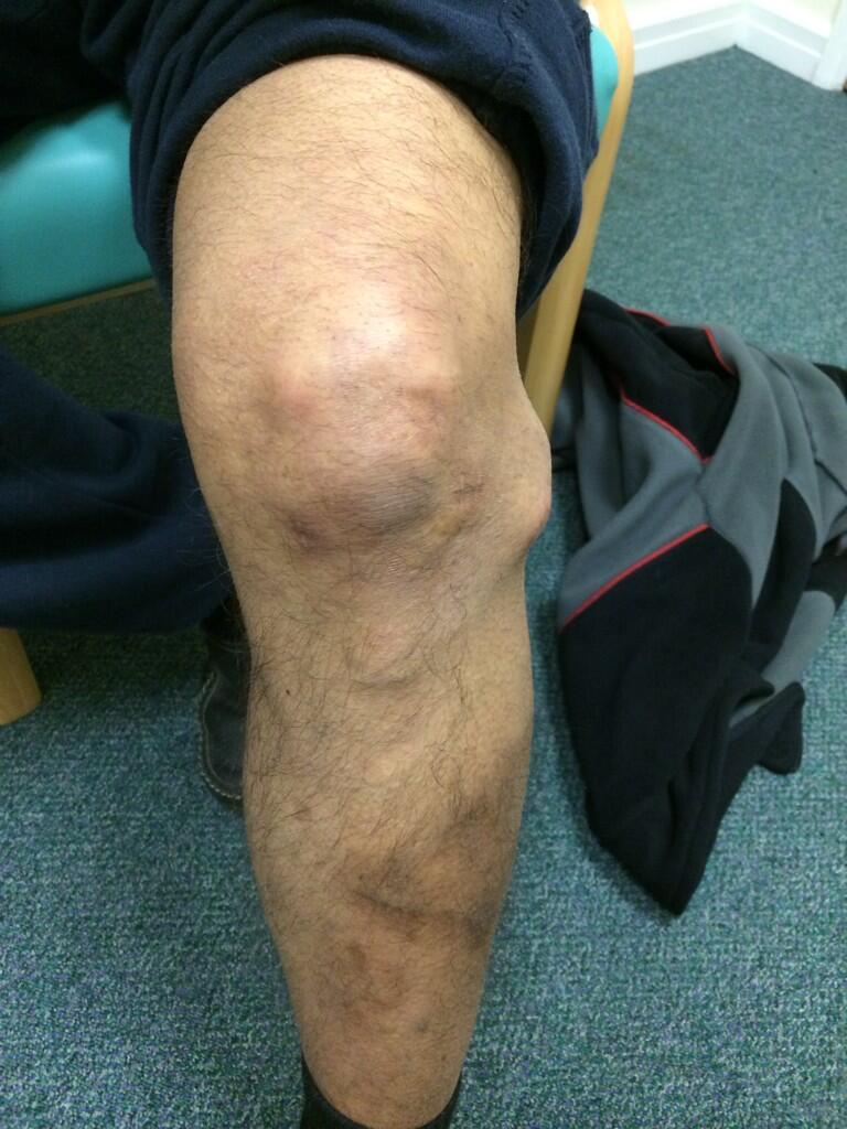 The Sp⚽️rts Physio on Twitter: "Knee gurus, 1/52 after meniscal cyst op