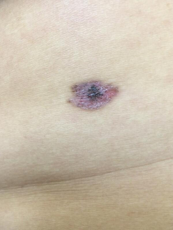 سرطان جلدي قاعدي تم استئصاله جراحيا من مريضة فلبينية

كانت وايد خايفة ان السرطان ميلانوما
بس الحمدلله طلع قاعدي