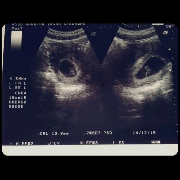 MariaNovieddy's tweet photo. Hasil USG :){}♥ http://t.co/pGiJaQxMYP