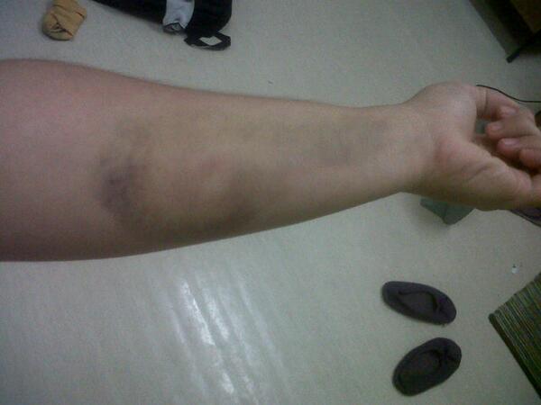 angey_ang's tweet photo. Can't explain the numbing pain I felt. Floppy arm. http://t.co/leIorq9gNw