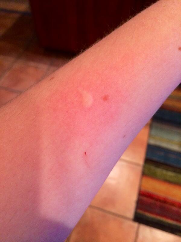 littlelinnyloo's tweet photo. Went outside for two minutes and this happens... #killermosquitos #fuckyou http://t.co/jbkV7VvTOB