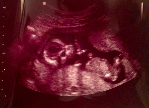 emily_ahern's tweet photo. My heart is overflowing with love ❤️ 
#howgreatisOurGod 
#ourlittlemiracle http://t.co/6B0pIO2PKT