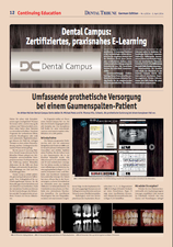 05/20/2014 Complete prosthetic restoration in a patient with cleft palate. Read more here: dental-campus.com/news/complete-…