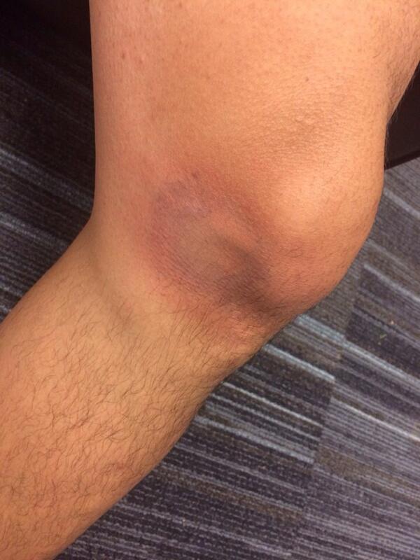 타구맞고 오분후^^ 뚜껑은 피했네요^^ 럭키!! 아마 내일되면 부기와 멍이 엄청 커질듯..