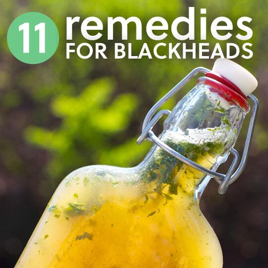 everydayroots's tweet photo. 11 Simple #Remedies to Get Rid of #Blackheads http://t.co/j5GczIXuMH http://t.co/sR2yDReSF9