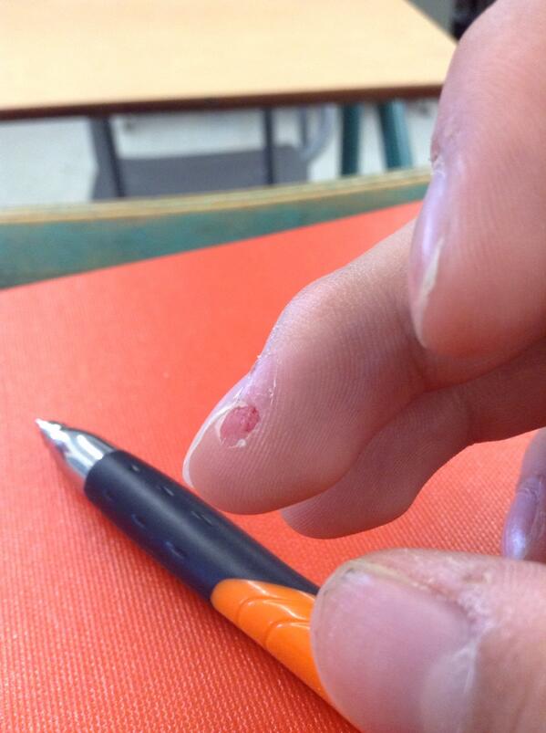 zkiiffs9's tweet image. Blisters on blisters #pitcherproblems #ow