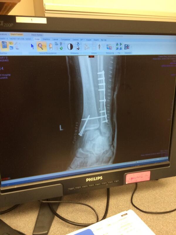 Ranta16's tweet photo. Ankle after surgery, old cast off new one on #4moreweeks http://t.co/DH0LCLIV2L